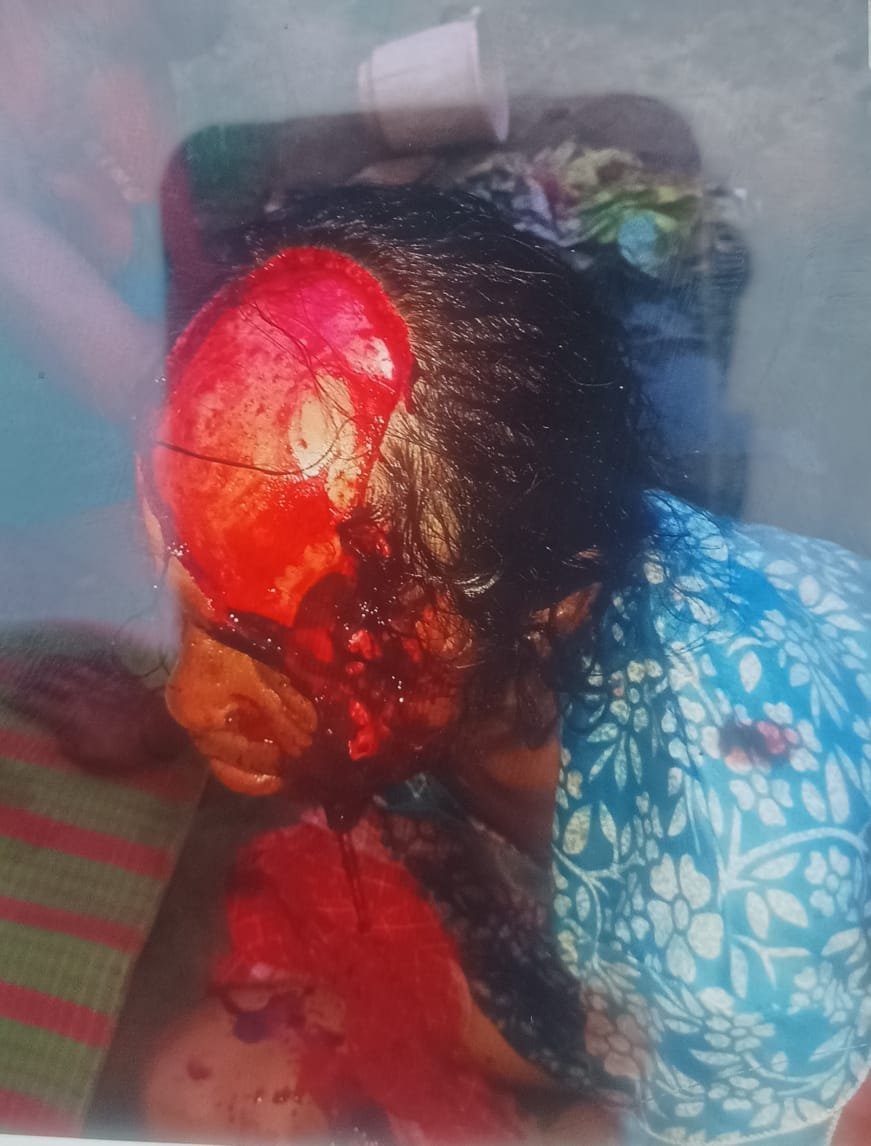 पलेवा में भालुओं का आतंक, ग्रामीण दहशत में; घर से निकलते ही महिला पर 4 भालुओं ने किया हमला